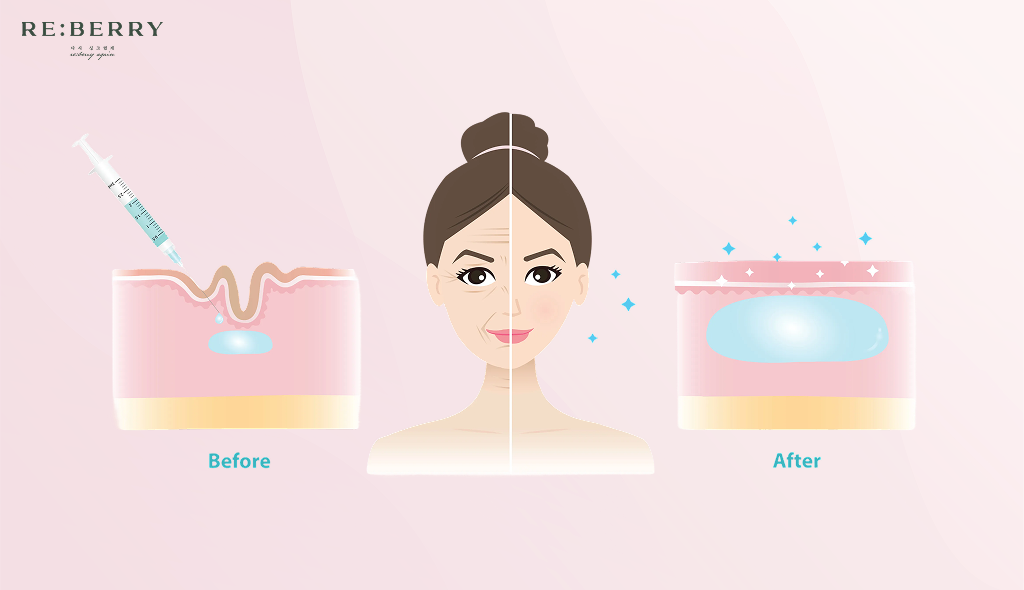 a graphical representation of volume restoration on skin layer with dermal fillers