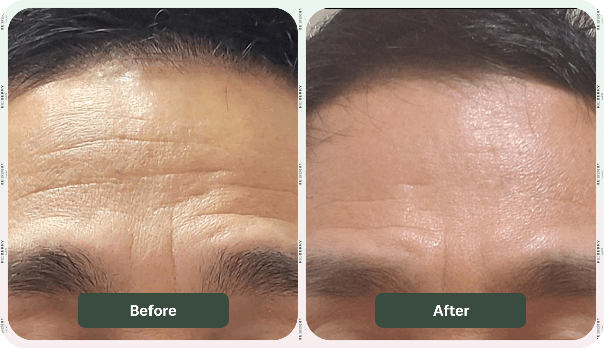 before and after botox injection