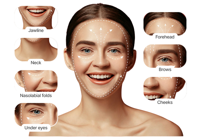 thread lift treatment areas on face