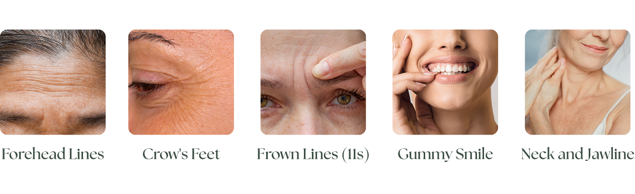 an image showing the key areas to treat with botox in 60s