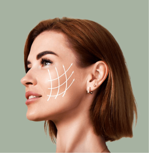 a female celebrity with graphical lines on cheek who have had thread lift