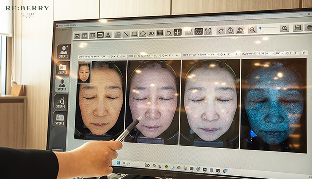 facial analysis for skin booster injection at Reberry clinic