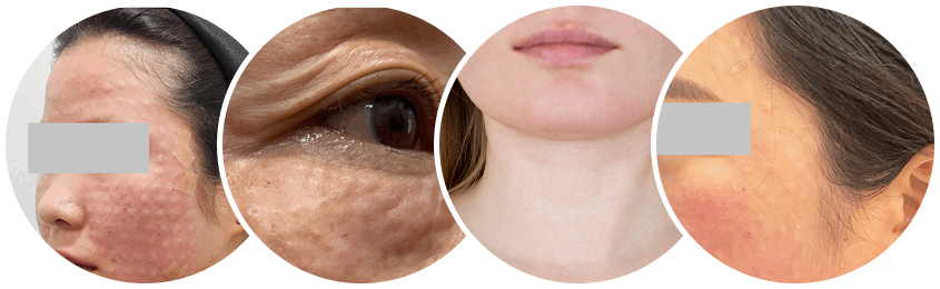 rejuran healer injection result on different facial and body areas
