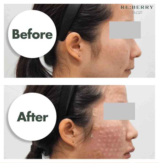 before and after image of long lasting result of rejuran healer