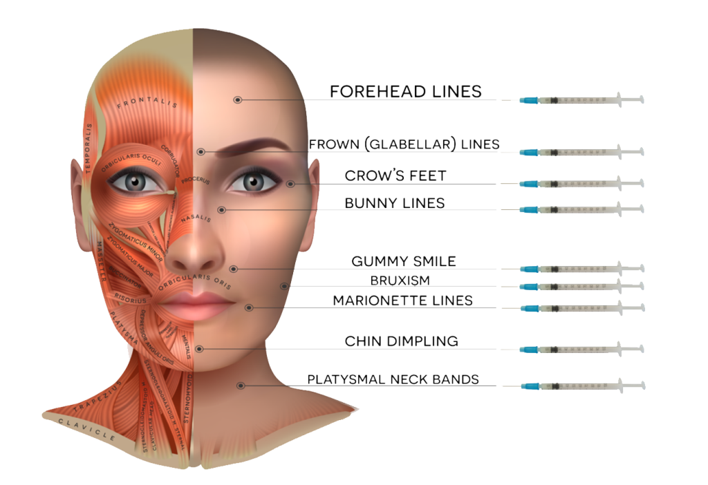representation of areas treated by botox effectively